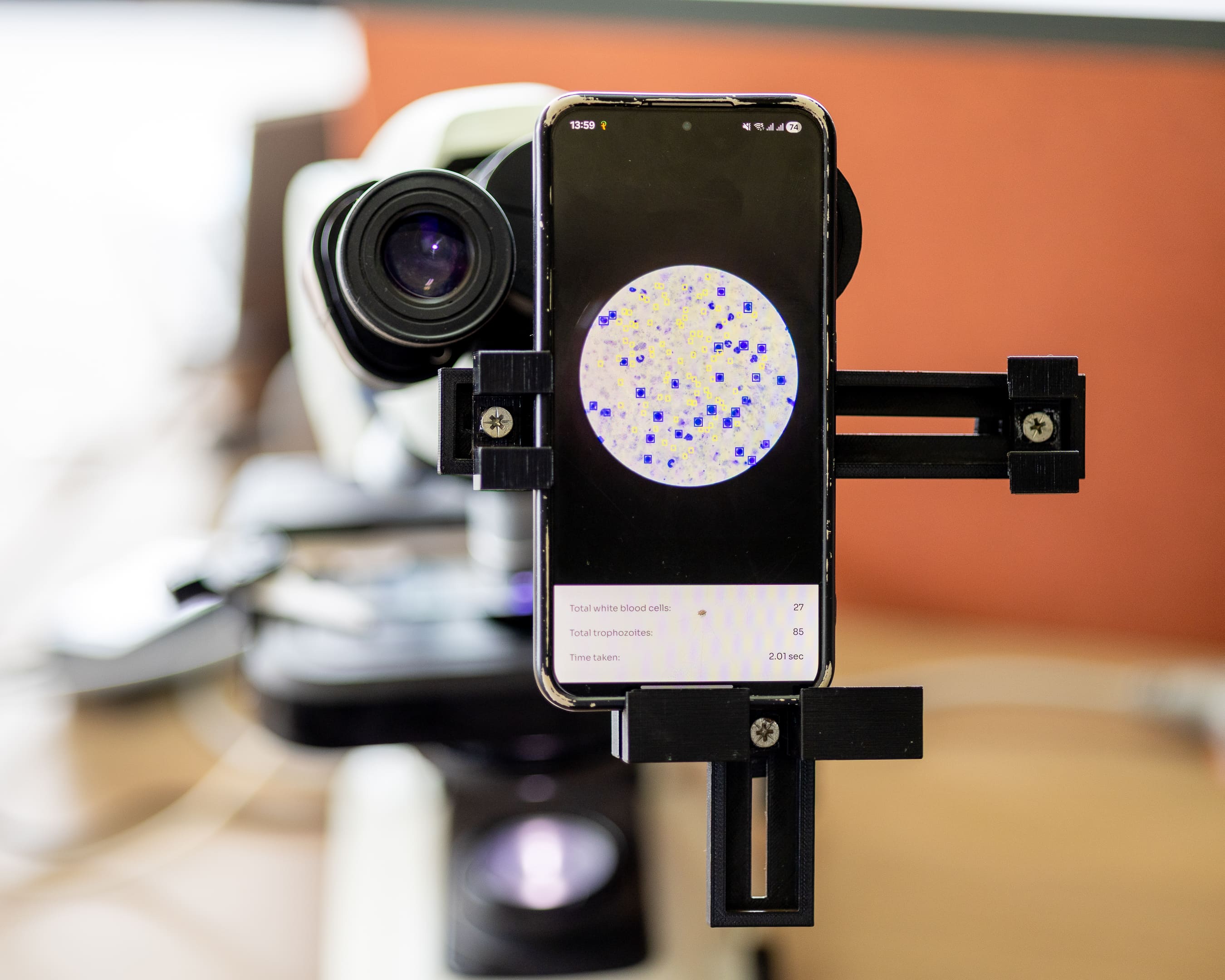 A smartphone mounted to a microscope with the Lab's 3D-printed Ocular adapter, its screen showing a blood smear with detected malaria parasites outlined and a count of white blood cells and trophozoites